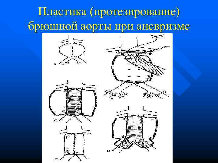 Пластика (протезирование) брюшной аорты при аневризме 