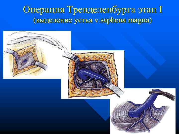 Операция Тренделенбурга этап I (выделение устья v. saphena magna) 