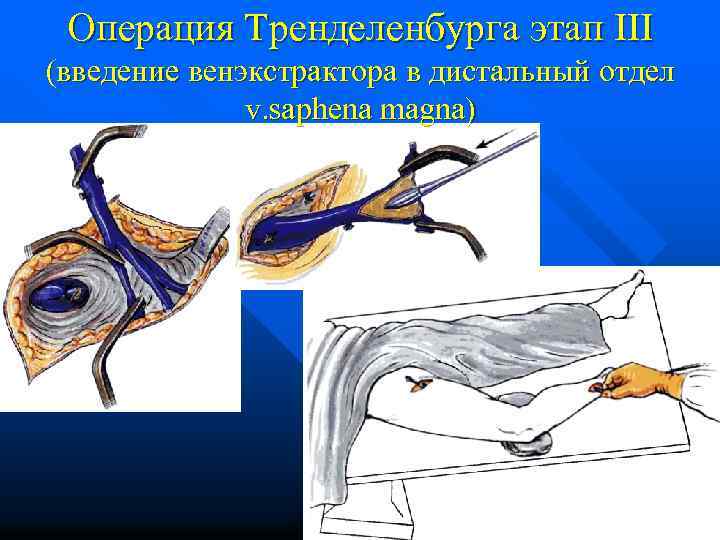 Операция Тренделенбурга этап III (введение венэкстрактора в дистальный отдел v. saphena magna) 