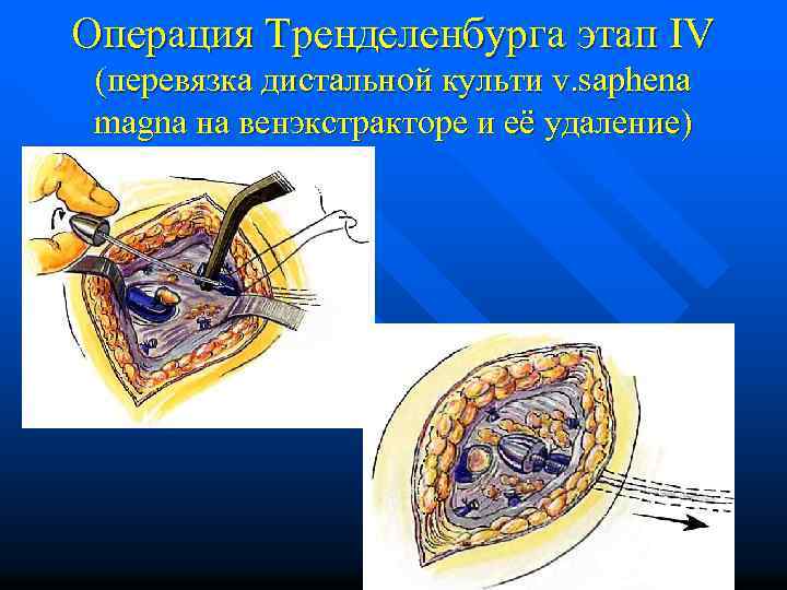 Операция Тренделенбурга этап IV (перевязка дистальной культи v. saphena magna на венэкстракторе и её