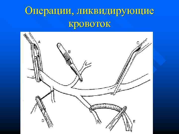 Операции, ликвидирующие кровоток 