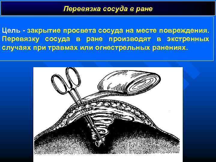 Перевязка сосуда в ране Цель - закрытие просвета сосуда на месте повреждения. Перевязку сосуда