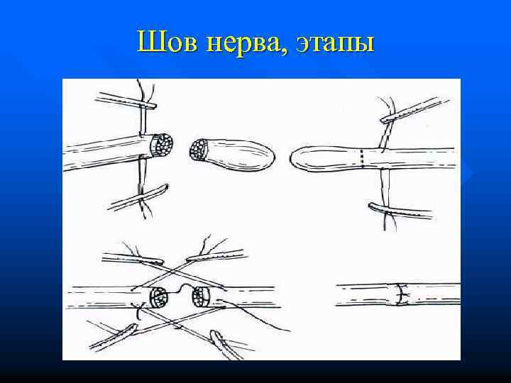 Шов нерва, этапы 