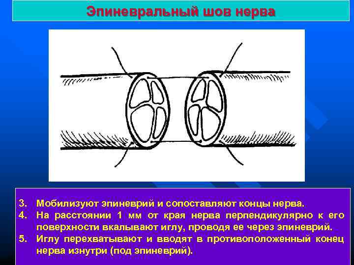 Эпиневральный шов нерва 3. Мобилизуют эпиневрий и сопоставляют концы нерва. 4. На расстоянии 1