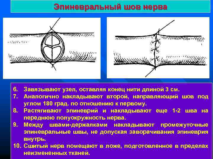 Эпиневральный шов нерва 6. Завязывают узел, оставляя конец нити длиной 3 см. 7. Аналогично