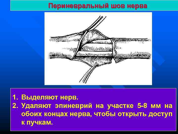 Периневральный шов нерва 1. Выделяют нерв. 2. Удаляют эпиневрий на участке 5 -8 мм