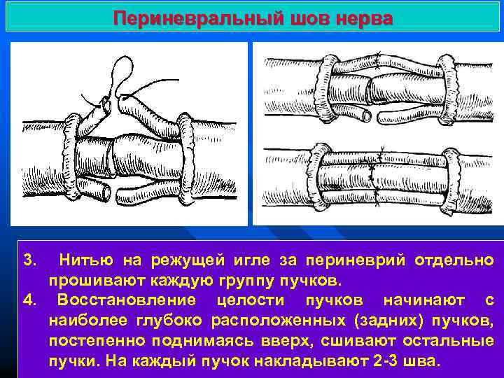 Периневральный шов нерва 3. Нитью на режущей игле за периневрий отдельно прошивают каждую группу