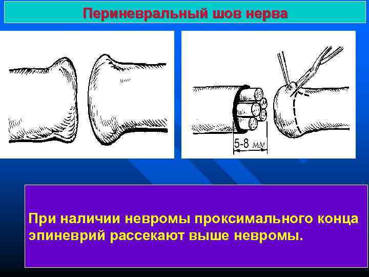 Периневральный шов нерва При наличии невромы проксимального конца эпиневрий рассекают выше невромы. 
