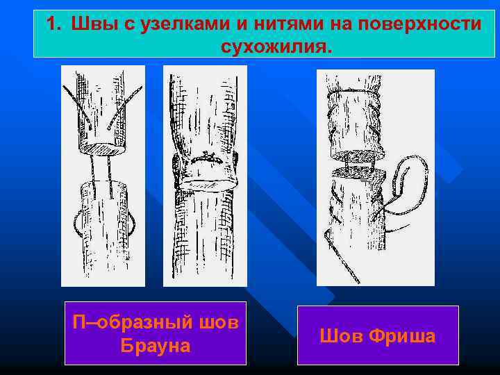 1. Швы с узелками и нитями на поверхности сухожилия. П–образный шов Брауна Шов Фриша