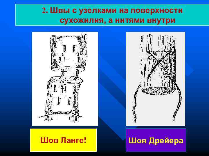2. Швы с узелками на поверхности сухожилия, а нитями внутри Шов Ланге! Шов Дрейера