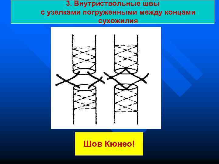 3. Внутриствольные швы с узелками погруженными между концами сухожилия Шов Кюнео! 