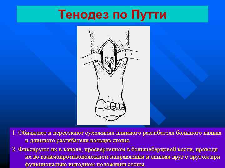 Тенодез по Путти 1. Обнажают и пересекают сухожилия длинного разгибателя большого пальца и длинного