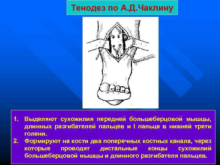 Тенодез по А. Д. Чаклину 1. Выделяют сухожилия передней большеберцовой мышцы, длинных разгибателей пальцев