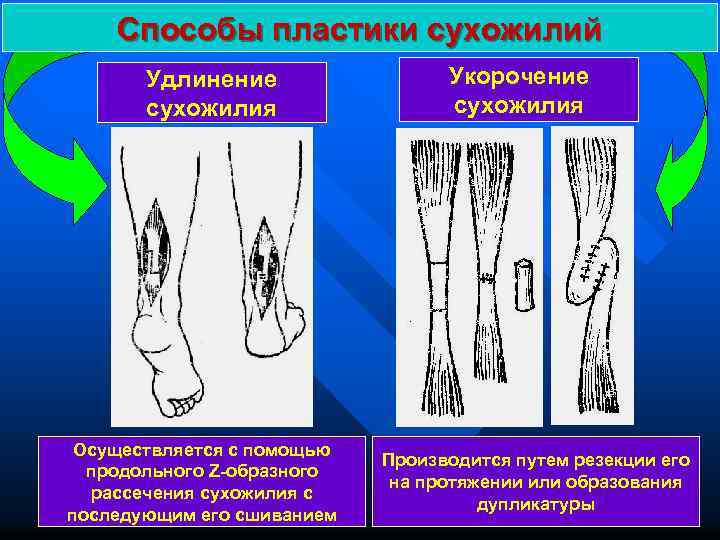 Способы пластики сухожилий Удлинение сухожилия Осуществляется с помощью продольного Z-образного рассечения сухожилия с последующим