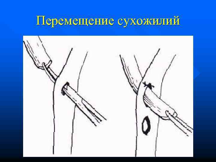 Перемещение сухожилий 