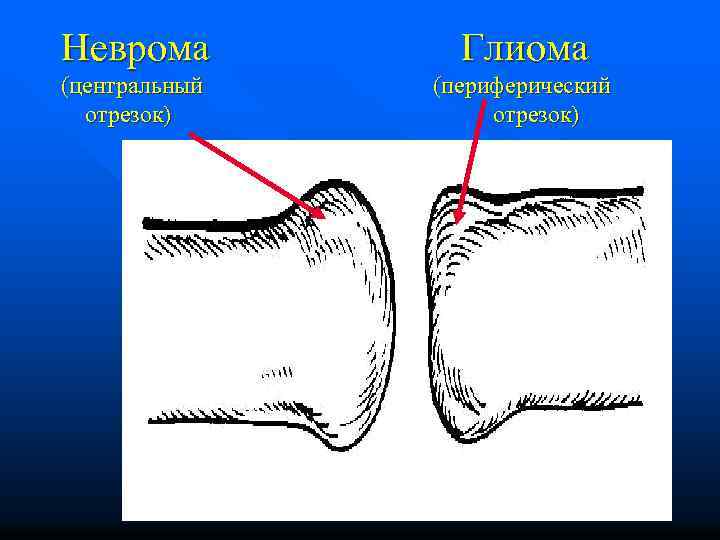 Неврома Глиома (центральный отрезок) (периферический отрезок) 