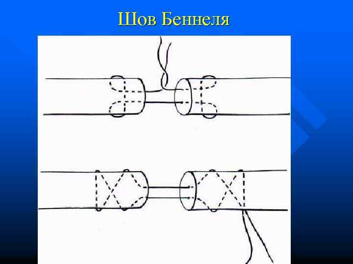 Шов Беннеля 