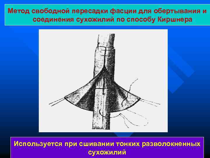 Метод свободной пересадки фасции для обертывания и соединения сухожилий по способу Киршнера Используется при