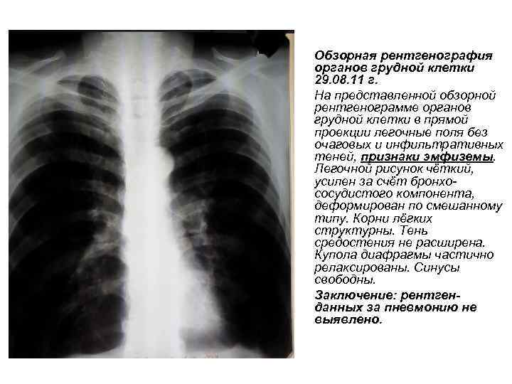 Обзорная рентгенография органов грудной клетки 29. 08. 11 г. На представленной обзорной рентгенограмме органов