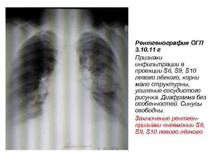 Рентгенография ОГП 3. 10. 11 г Признаки инфильтрации в проекции S 6, S 9,