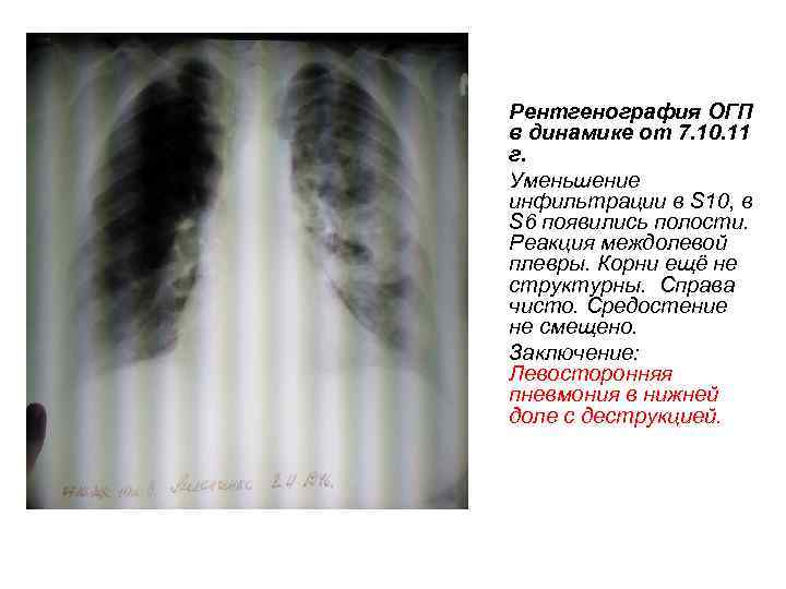 Рентгенография ОГП в динамике от 7. 10. 11 г. Уменьшение инфильтрации в S 10,