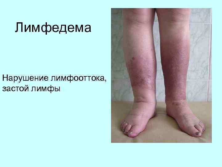 Лимфедема Нарушение лимфооттока, застой лимфы 