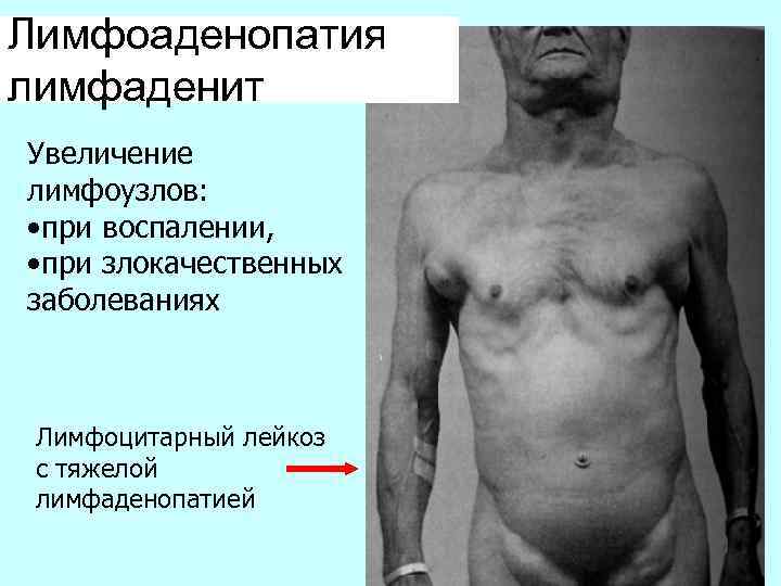 Лимфоаденопатия лимфаденит Увеличение лимфоузлов: • при воспалении, • при злокачественных заболеваниях Лимфоцитарный лейкоз с