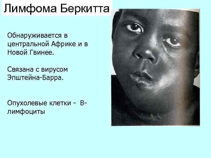 Лимфома Беркитта Обнаруживается в центральной Африке и в Новой Гвинее. Связана с вирусом Эпштейна-Барра.