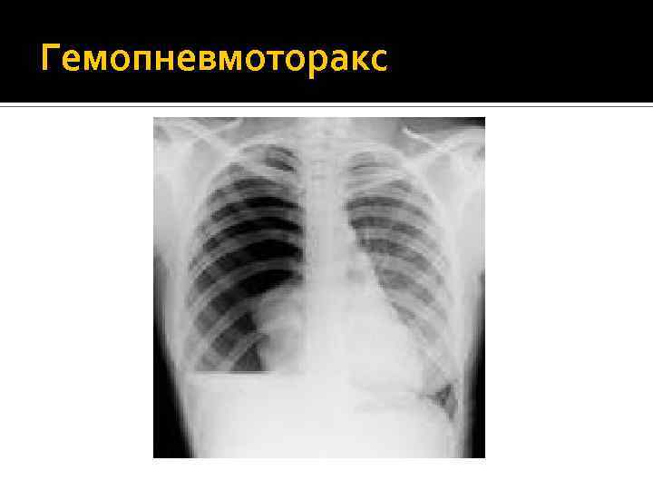Гемопневмоторакс 