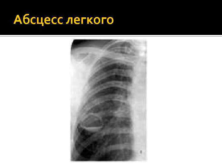 Абсцесс легкого 