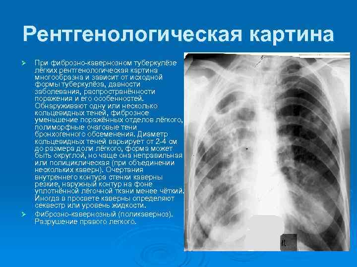 Рентгенологическая картина Ø Ø При фиброзно-кавернозном туберкулёзе лёгких рентгенологическая картина многообразна и зависит от