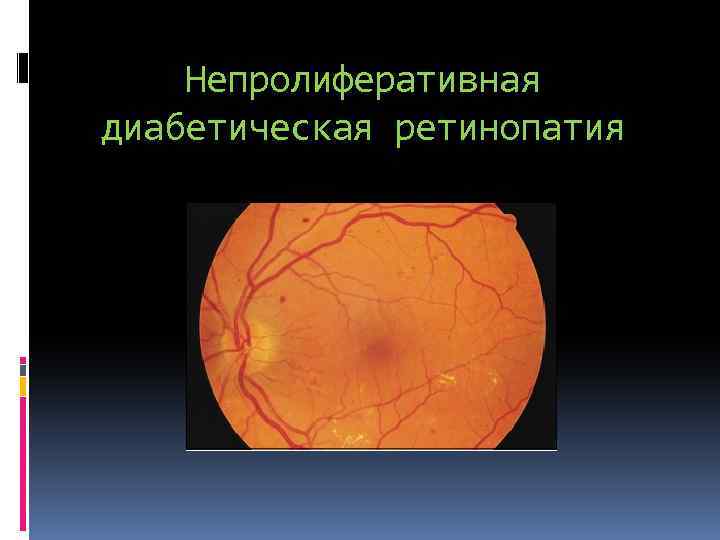 Непролиферативная диабетическая ретинопатия 