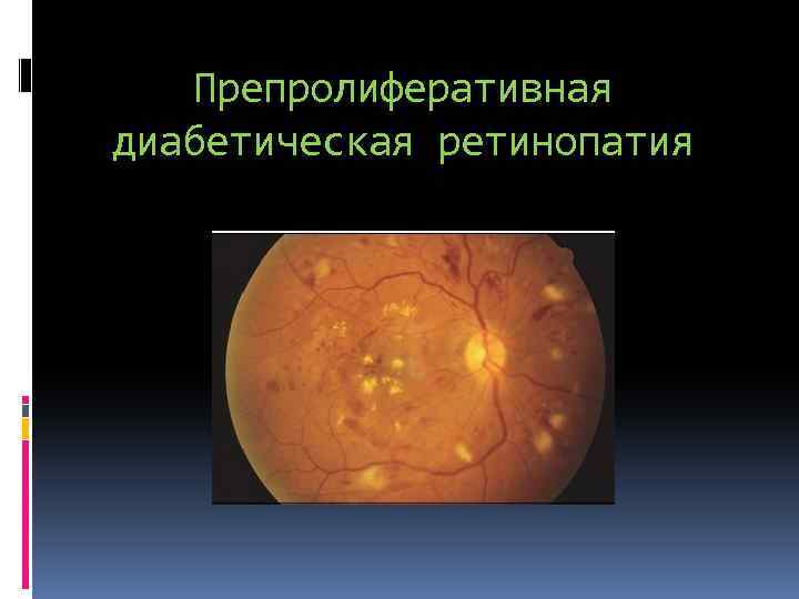 Препролиферативная диабетическая ретинопатия 