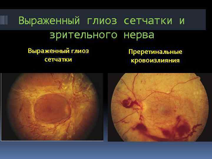 Выраженный глиоз сетчатки и зрительного нерва Выраженный глиоз сетчатки Преретинальные кровоизлияния 