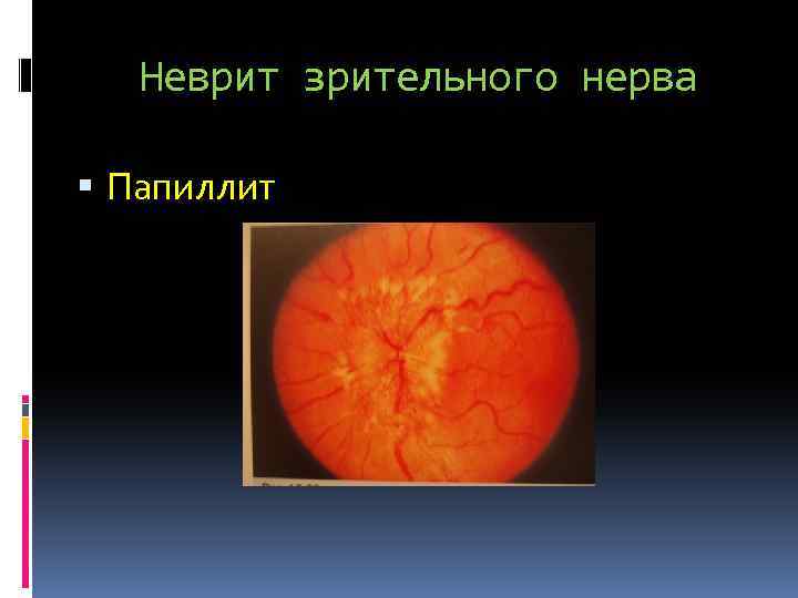 Неврит зрительного нерва Папиллит 