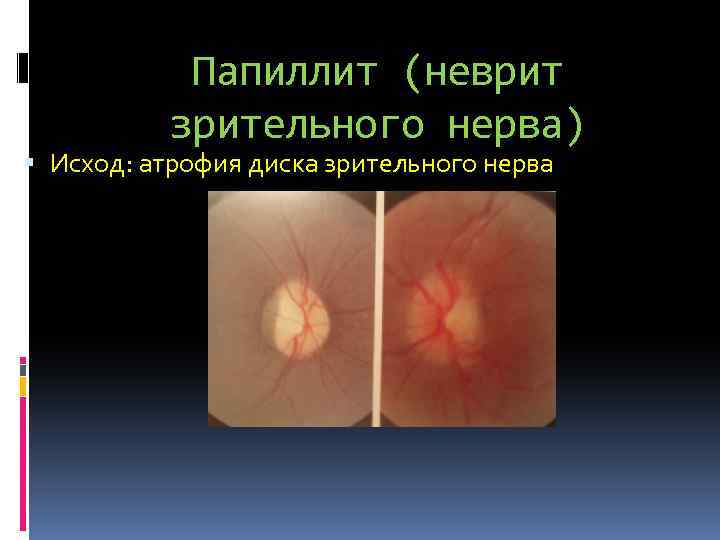 Папиллит (неврит зрительного нерва) Исход: атрофия диска зрительного нерва 