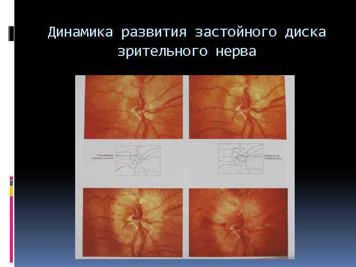 Динамика развития застойного диска зрительного нерва 