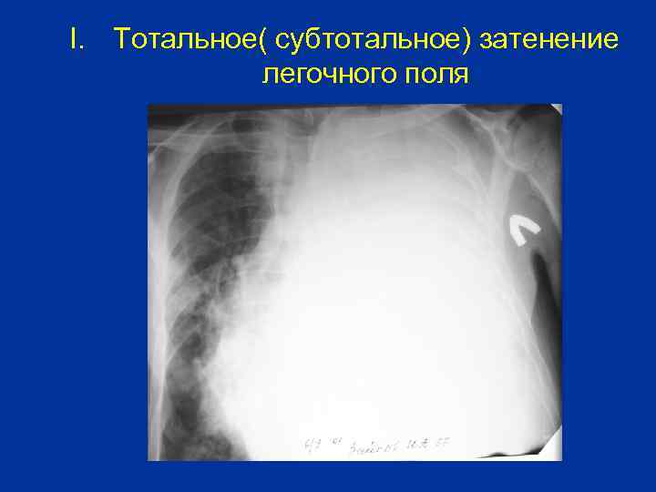 I. Тотальное( субтотальное) затенение легочного поля 