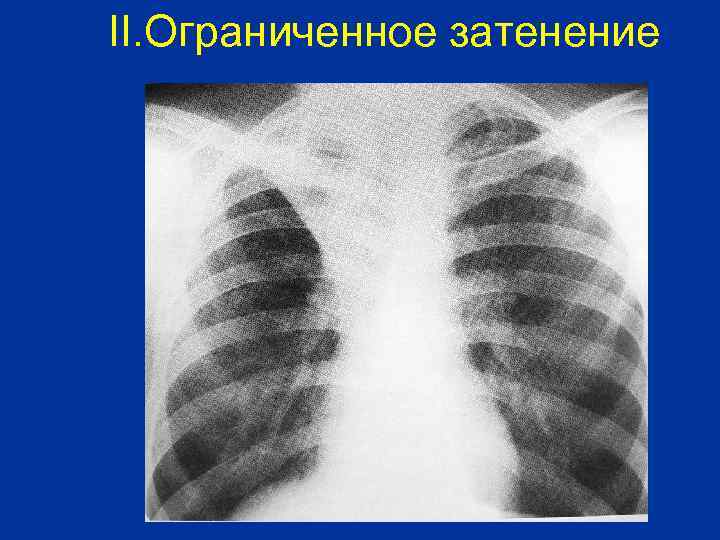 II. Ограниченное затенение 