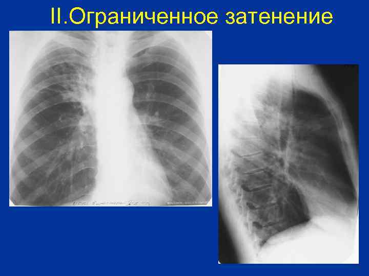 II. Ограниченное затенение 