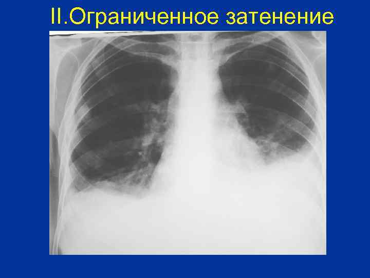 II. Ограниченное затенение 