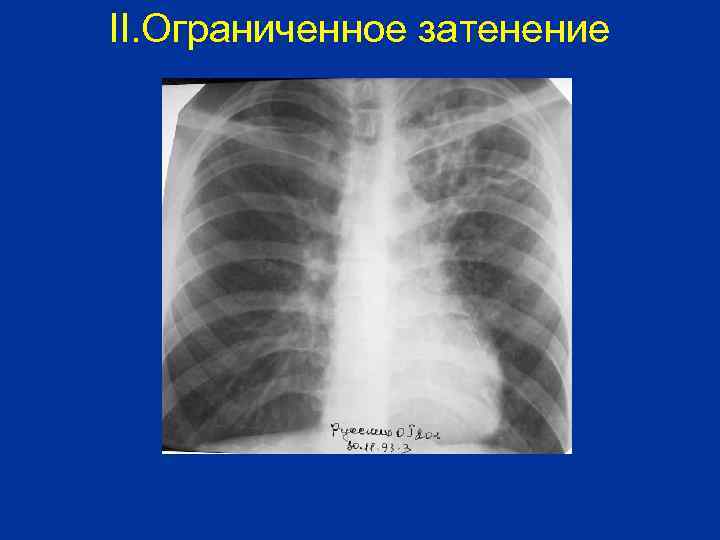 II. Ограниченное затенение 