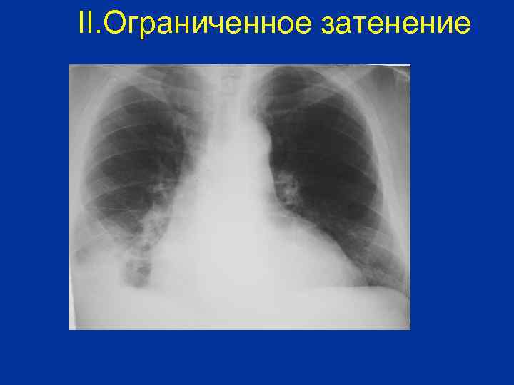 II. Ограниченное затенение 