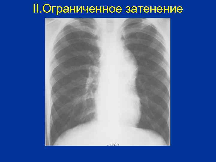 II. Ограниченное затенение 