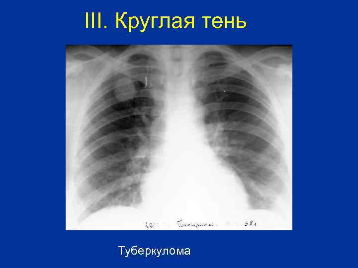 III. Круглая тень Туберкулома 