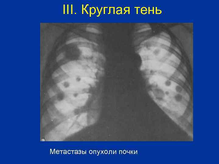 III. Круглая тень Метастазы опухоли почки 