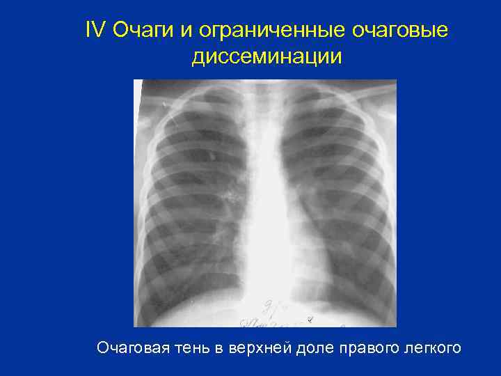 IV Очаги и ограниченные очаговые диссеминации Очаговая тень в верхней доле правого легкого 