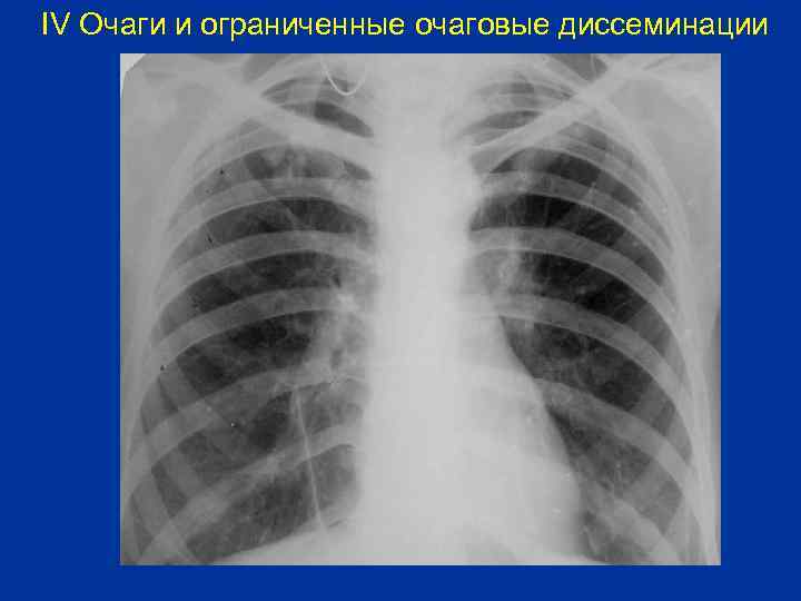 IV Очаги и ограниченные очаговые диссеминации 