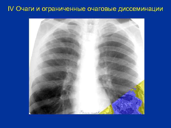 IV Очаги и ограниченные очаговые диссеминации 