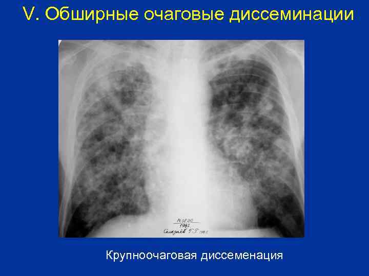 V. Обширные очаговые диссеминации Крупноочаговая диссеменация 